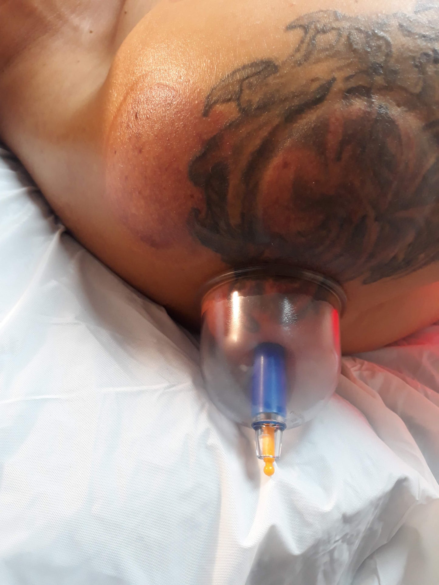 Cupping Therapy Session